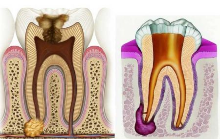 Гранулема зуба: причины и способы лечения